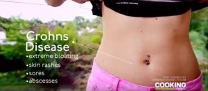 Crohn Hastalığının Belirtileri