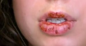 Crohn hastalığında örneğin dudaktaki yaralar