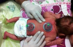 Aidin Salih önderliğinde yapılan hacamat uygullamalarından biri