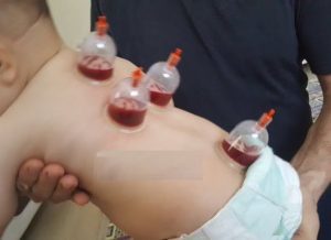 Bebeklere ve çocuklara hacamat yapılır mı