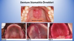 Denture stomatitis hastaliginda propolis