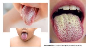 Propolis Pamukçuk Oluşumunu Engeller